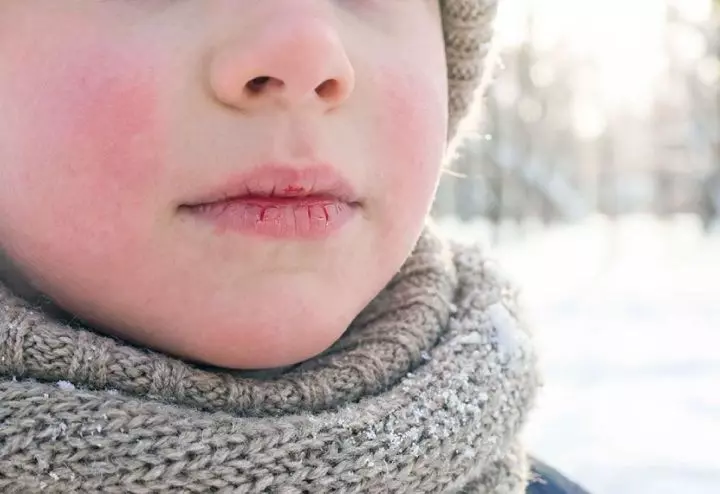 Close-Up of Chapped Lips in Cold Winter Air
