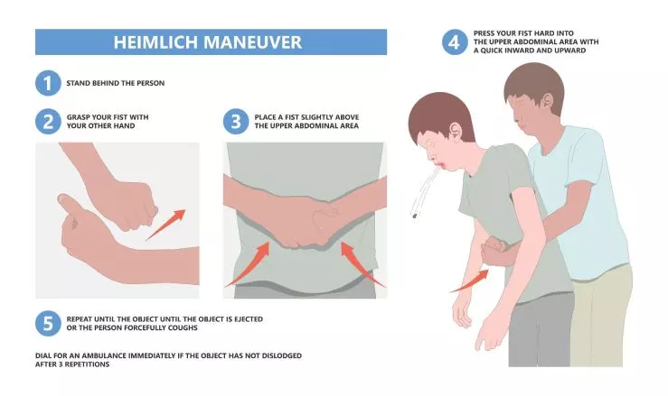 Heimlich Maneuver.jpeg