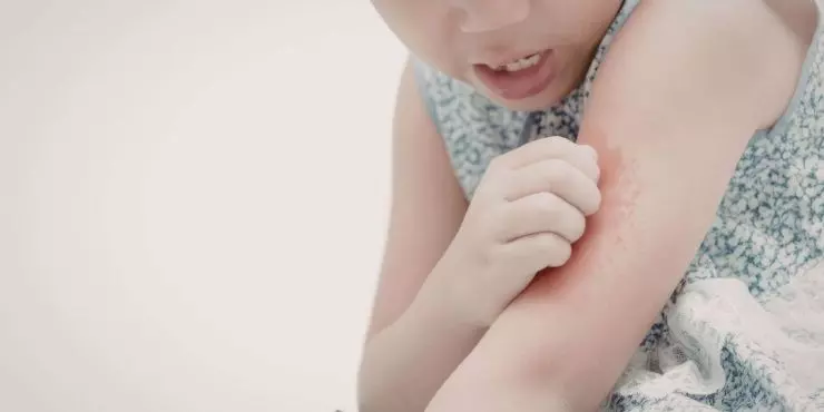 Mosquito bite on child's arm