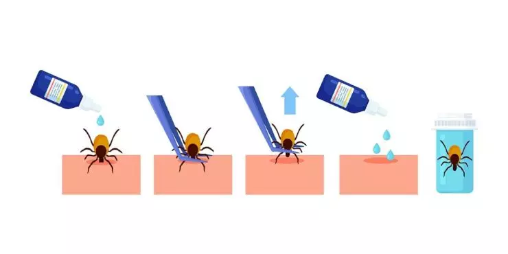 how to safely remove a tick at home