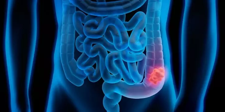colorectal-cancer-and-importance-screenings.jpg