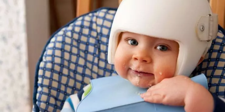 Baby with helmet eating in high chair