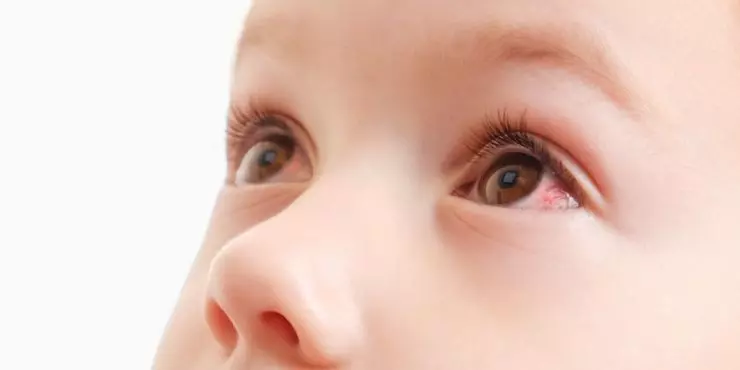 The three types of pink eye and how they differ