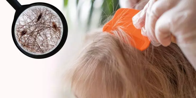 Image-1--head-lice-under-magnifying-glass-on-child-scalp.jpg